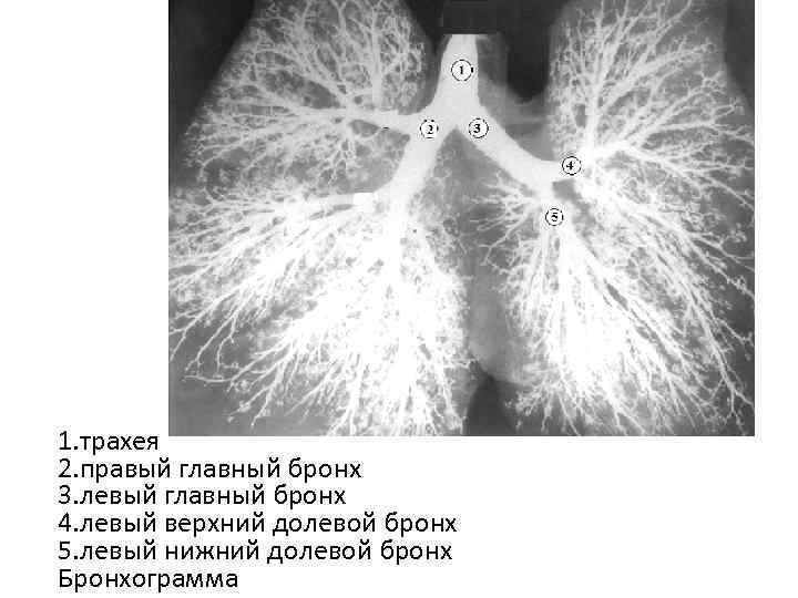 1. трахея 2. правый главный бронх 3. левый главный бронх 4. левый верхний долевой