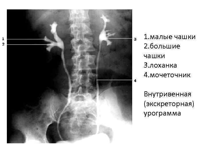 1. малые чашки 2. большие чашки 3. лоханка 4. мочеточник Внутривенная (экскреторная) урограмма 