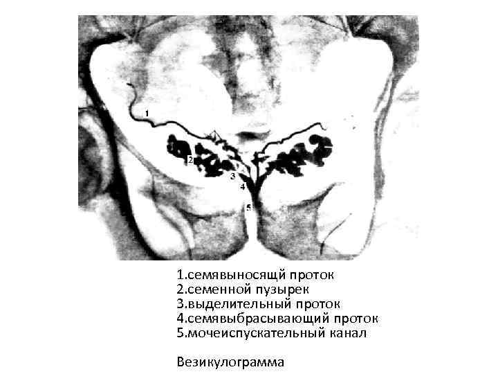 1. семявыносящй проток 2. семенной пузырек 3. выделительный проток 4. семявыбрасывающий проток 5. мочеиспускательный