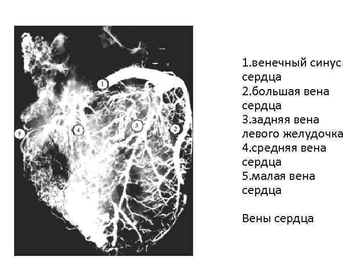 1. венечный синус сердца 2. большая вена сердца 3. задняя вена левого желудочка 4.