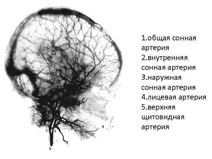 1. общая сонная артерия 2. внутренняя сонная артерия 3. наружная сонная артерия 4. лицевая