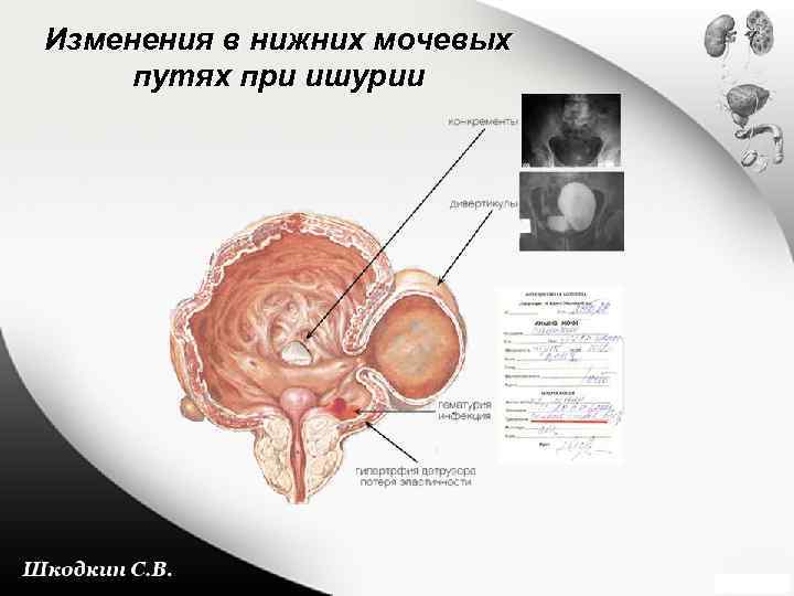 Изменения в нижних мочевых путях при ишурии 