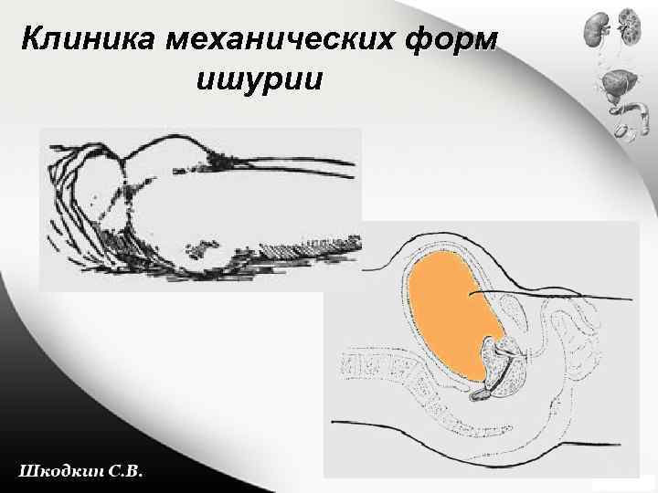 Клиника механических форм ишурии 