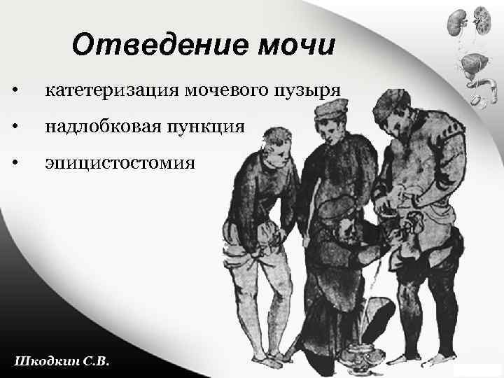 Отведение мочи • катетеризация мочевого пузыря • надлобковая пункция • эпицистостомия 