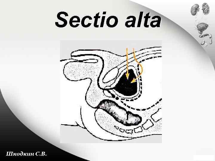 Sectio alta 