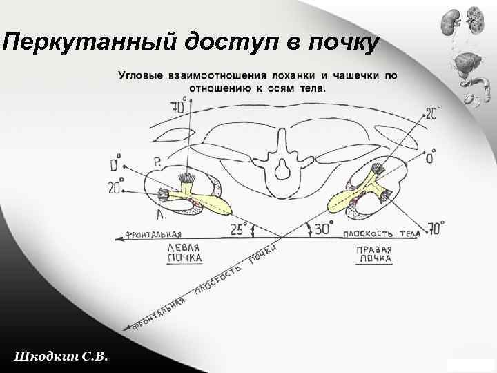 Перкутанный доступ в почку 