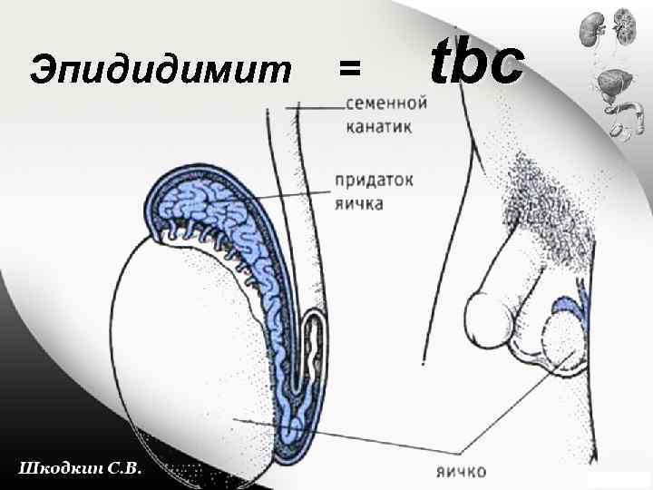 Эпидидимит = tbc 