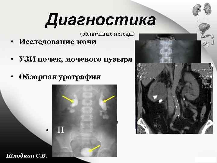 Диагностика (облигатные методы) • Исследование мочи • УЗИ почек, мочевого пузыря • Обзорная урография