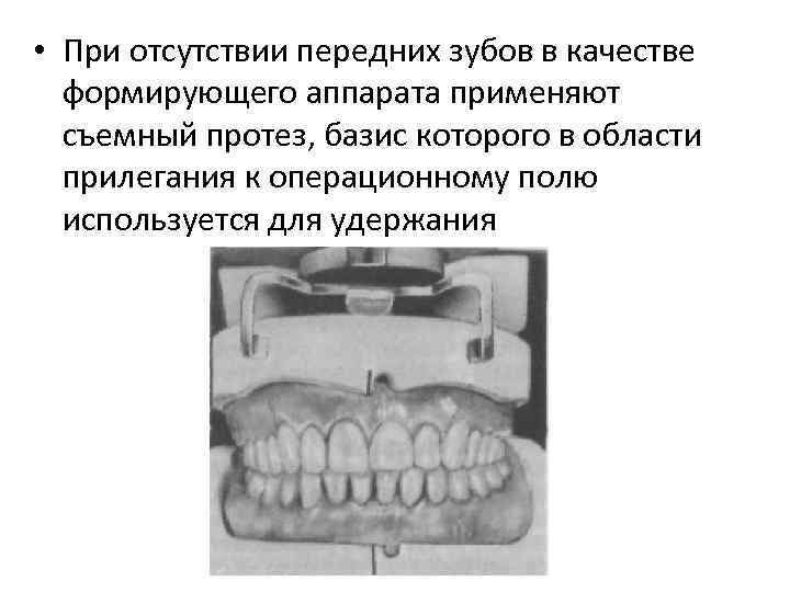  • При отсутствии передних зубов в качестве формирующего аппарата применяют съемный протез, базис