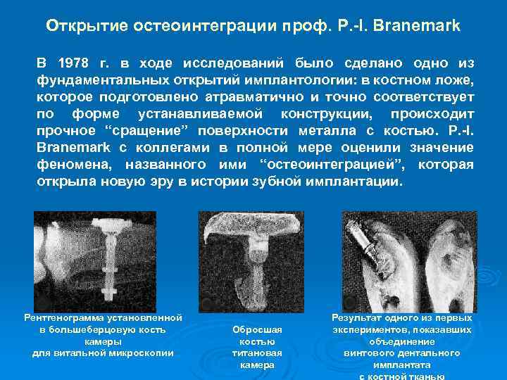 Открытие остеоинтеграции проф. P. -I. Branemark В 1978 г. в ходе исследований было сделано
