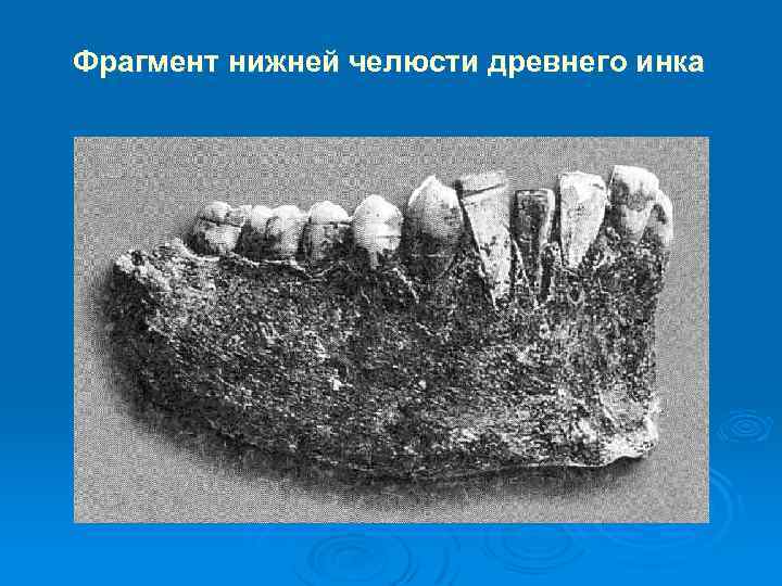 Фрагмент нижней челюсти древнего инка 