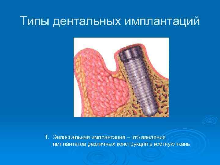 Типы дентальных имплантаций 1. Эндоссальная имплантация – это введение имплантатов различных конструкций в костную