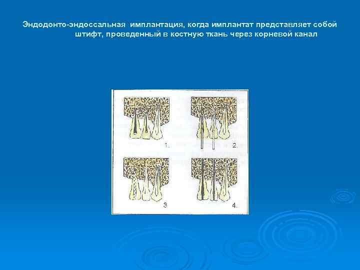 Эндодонто-эндоссальная имплантация, когда имплантат представляет собой штифт, проведенный в костную ткань через корневой канал