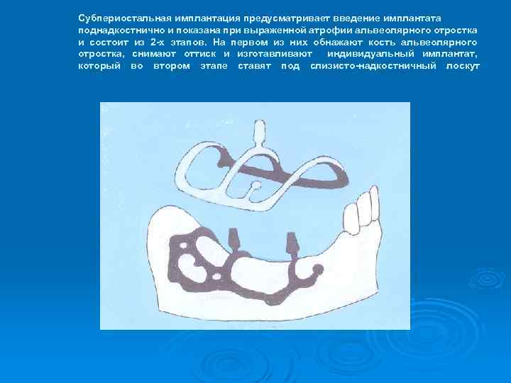 Субпериостальная имплантация предусматривает введение имплантата поднадкостнично и показана при выраженной атрофии альвеолярного отростка и