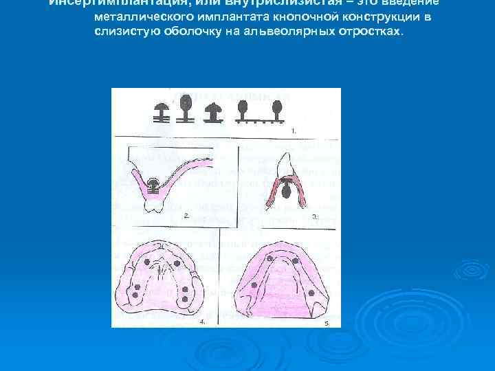 Инсертимплантация, или внутрислизистая – это введение металлического имплантата кнопочной конструкции в слизистую оболочку на