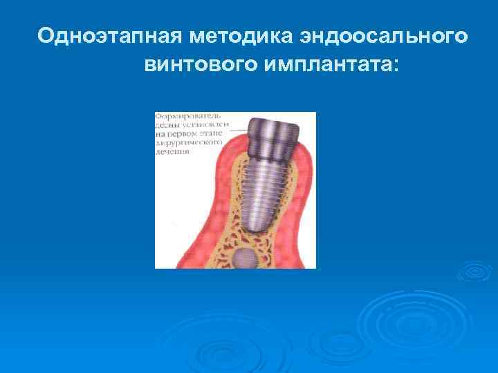 Одноэтапная методика эндоосального винтового имплантата: 
