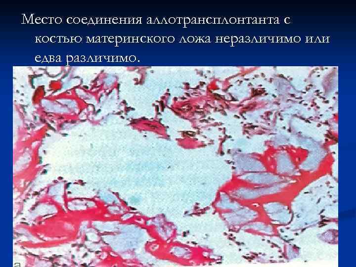 Место соединения аллотрансплонтанта с костью материнского ложа неразличимо или едва различимо. 