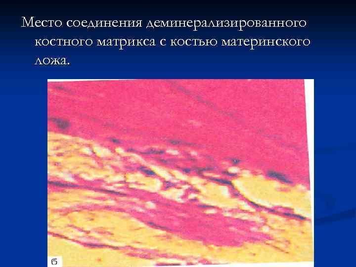 Место соединения деминерализированного костного матрикса с костью материнского ложа. 