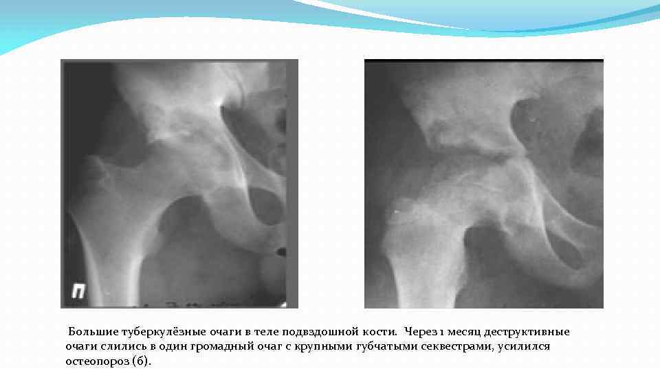  Большие туберкулёзные очаги в теле подвздошной кости. Через 1 месяц деструктивные очаги слились