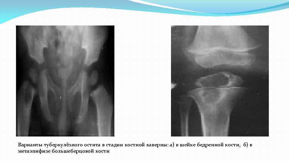  Варианты туберкулёзного остита в стадии костной каверны: а) в шейке бедренной кости, б)