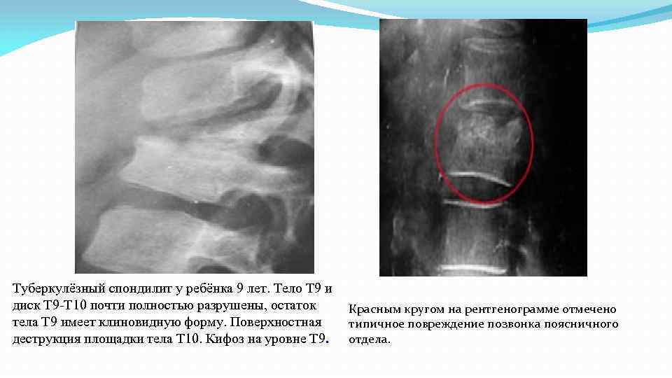 Туберкулёзный спондилит у ребёнка 9 лет. Тело Т 9 и диск Т 9 -Т