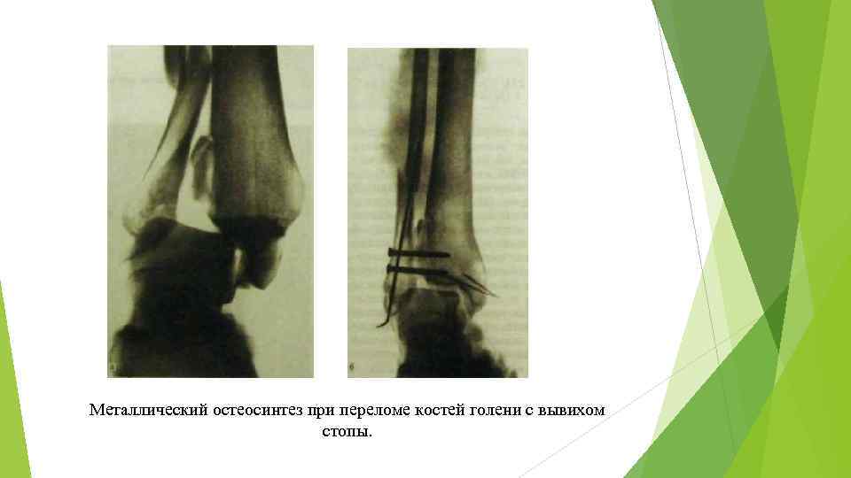 Металлический остеосинтез при переломе костей голени с вывихом стопы. 