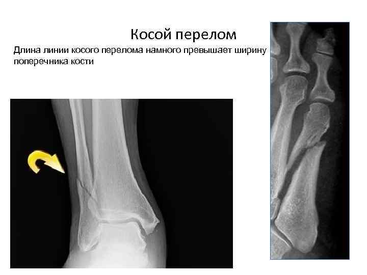 Косой перелом. Косой перелом большеберцовой кости рентген. Продольный перелом большеберцовой кости. Косой со смещением перелом отломков. Косой перелом большеберцовой кости биос.