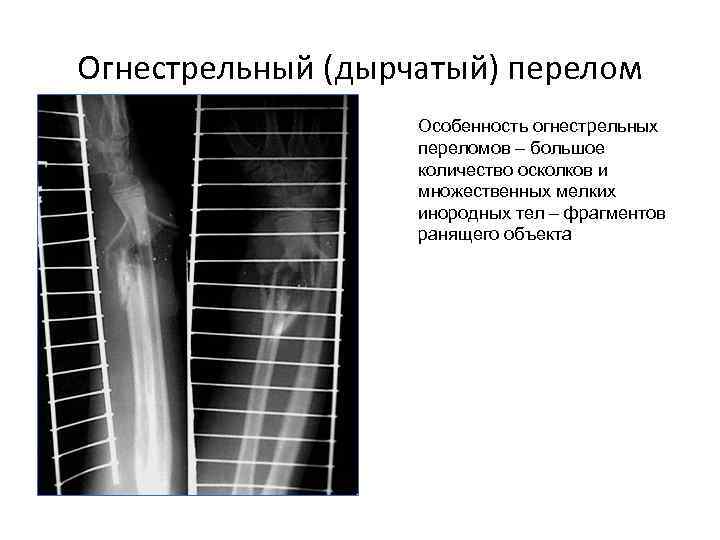 Дырчатый перелом