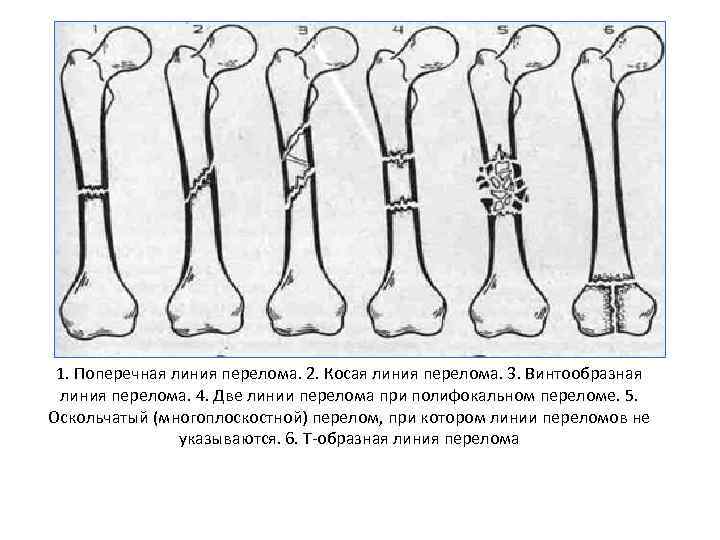 Рисунок перелома кости. Классификация переломов диафизарной части плечевой кости. Винтообразная линия перелома. Переломы диафиза бедра классификация. Классификация переломов трубчатых костей.
