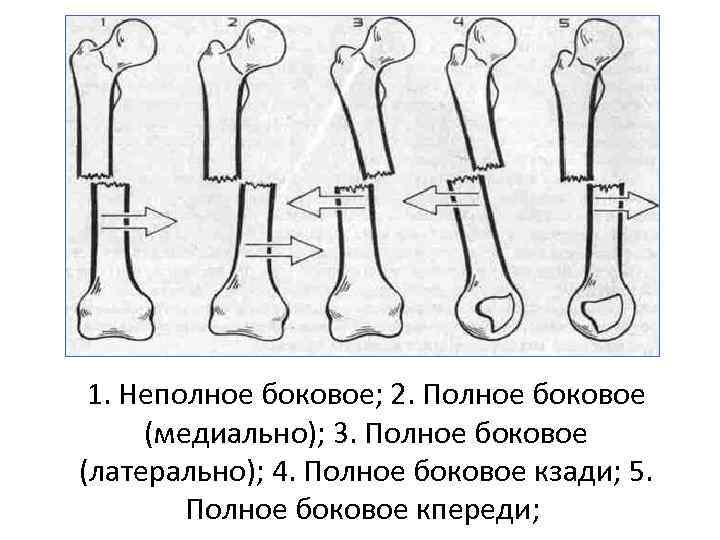 Закрытый перелом коленного сустава карта вызова