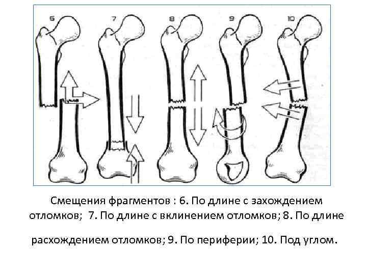 Смещение отломков кости. Косой перелом со смещением отломков по длине и с расхождением. Поперечный перелом с вклинением отломков. Перелом с захождением отломков по длине. Косой перелом с захождением отломков.