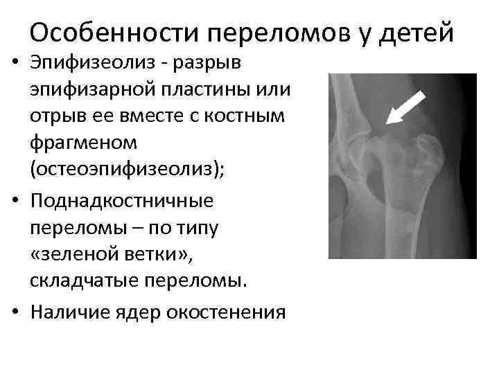 Особенности переломов у детей • Эпифизеолиз - разрыв эпифизарной пластины или отрыв ее вместе