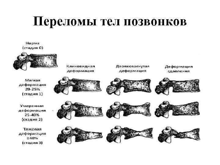 Компрессионный перелом позвоночника 1 степени у детей. Степени клиновидной деформации тел позвонков. Степени компрессионных переломов позвонков кт. Компрессионный перелом позвонка степени. Степени компрессионного перелома позвоночника.