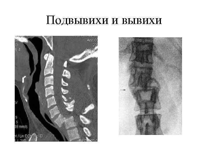 Подвывихи и вывихи 