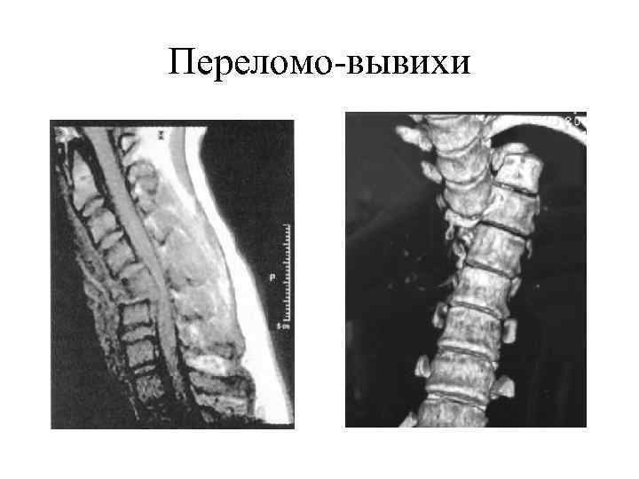 Компрессионный перелом позвоночника что это такое у детей фото и последствия