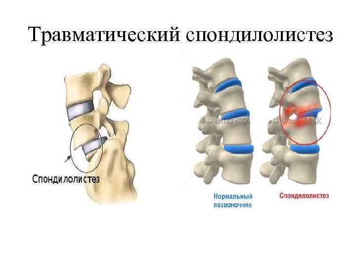 Спондилолистез