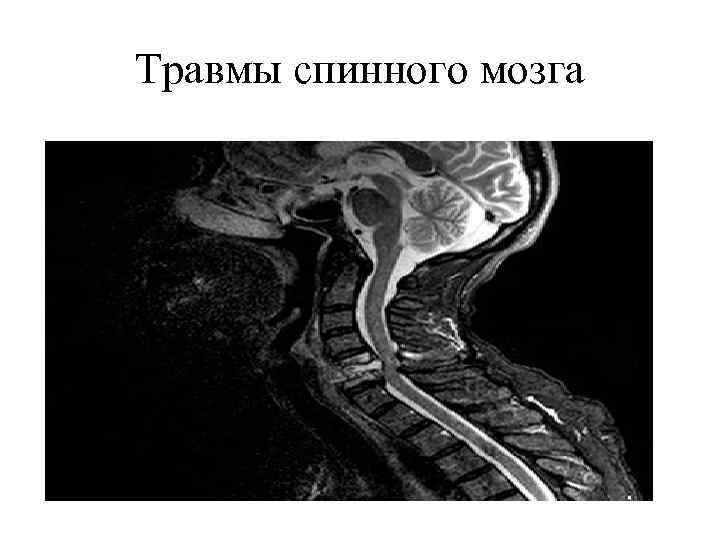 Сотрясение позвоночника. Классификация разрыва спинного мозга. Травмы головного и спинного мозга.