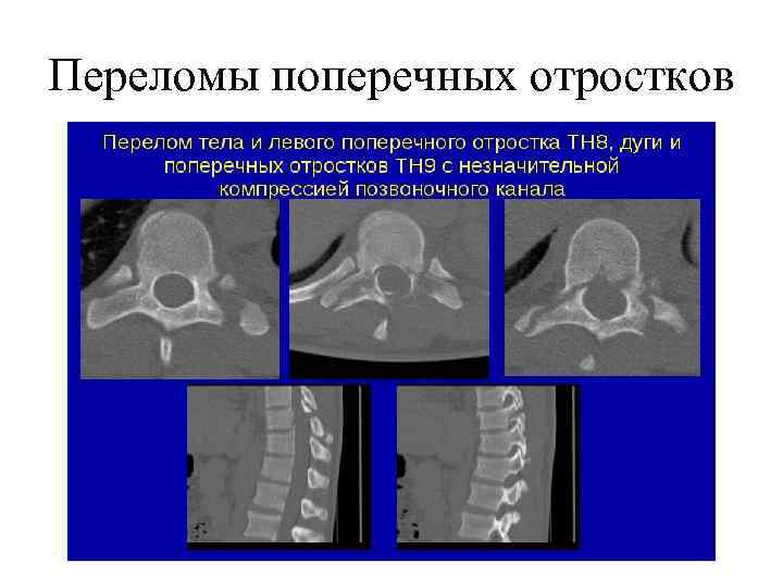 Переломы поперечных отростков 