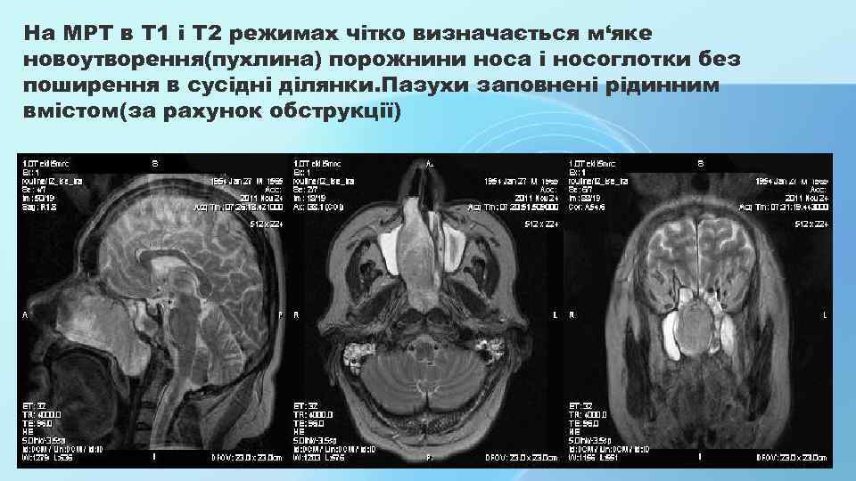 На МРТ в Т 1 і Т 2 режимах чітко визначається м‘яке новоутворення(пухлина) порожнини