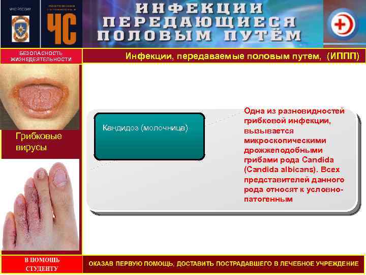 БЕЗОПАСНОСТЬ ЖИЗНЕДЕЯТЕЛЬНОСТИ Грибковые вирусы Инфекции, передаваемые половым путем, (ИППП) Кандидоз (молочница) Одна из разновидностей