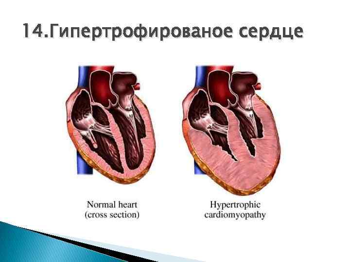 14. Гипертрофированое сердце 