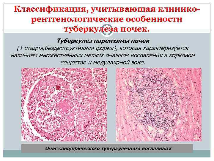 Классификация, учитывающая клиникорентгенологические особенности туберкулеза почек. Туберкулез паренхимы почек (1 стадия, бездеструктивная форма), которая