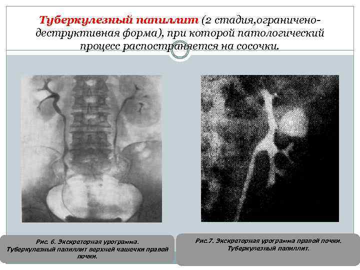Туберкулезный папиллит (2 стадия, ограниченодеструктивная форма), при которой патологический процесс распостраняется на сосочки. Рис.
