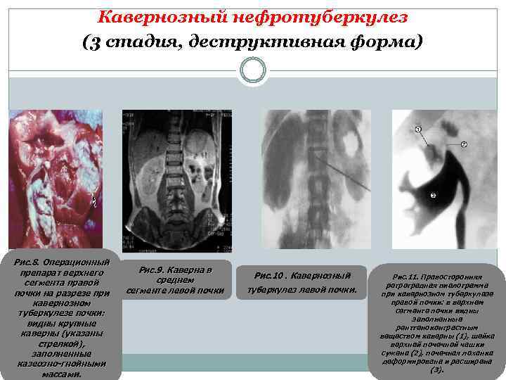 Кавернозный нефротуберкулез (3 стадия, деструктивная форма) Рис. 8. Операционный препарат верхнего сегмента правой почки