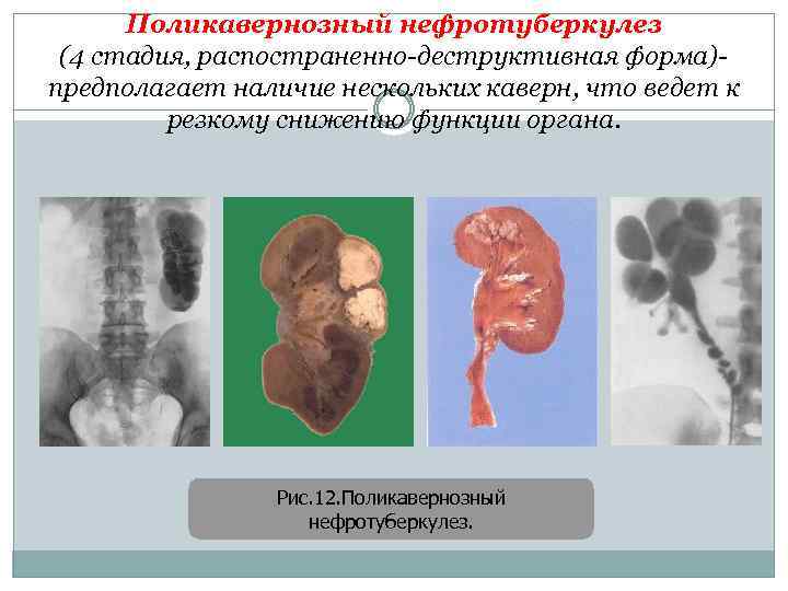 Поликавернозный нефротуберкулез (4 стадия, распостраненно-деструктивная форма)- предполагает наличие нескольких каверн, что ведет к резкому