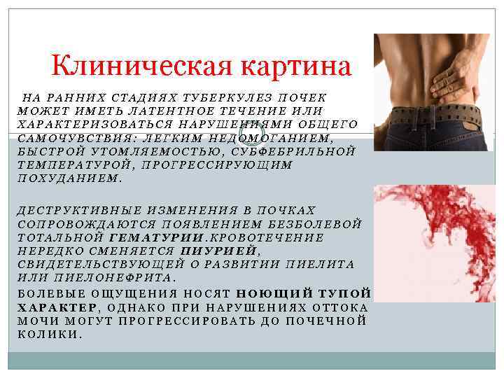 Клиническая картина НА РАННИХ СТАДИЯХ ТУБЕРКУЛЕЗ ПОЧЕК МОЖЕТ ИМЕТЬ ЛАТЕНТНОЕ ТЕЧЕНИЕ ИЛИ ХАРАКТЕРИЗОВАТЬСЯ НАРУШЕНИЯМИ