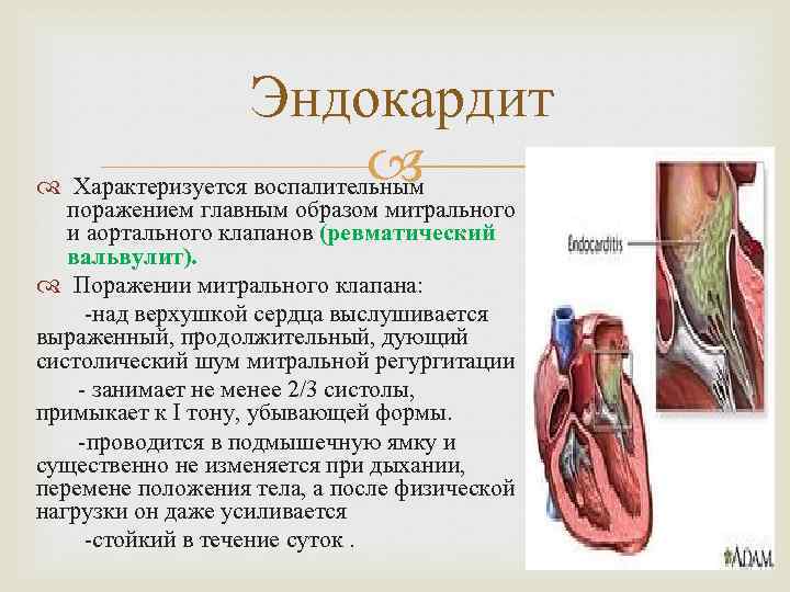 Эндокардит Характеризуется воспалительным поражением главным образом митрального и аортального клапанов (ревматический вальвулит). Поражении митрального