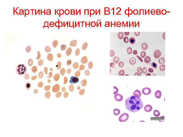 Картина крови при в12 дефицитной анемии периферической