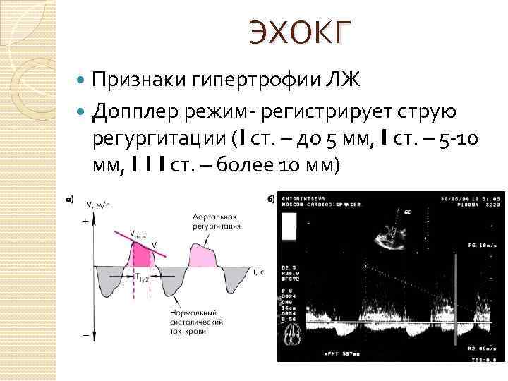 ЭХОКГ Признаки гипертрофии ЛЖ Допплер режим- регистрирует струю регургитации (I ст. – до 5