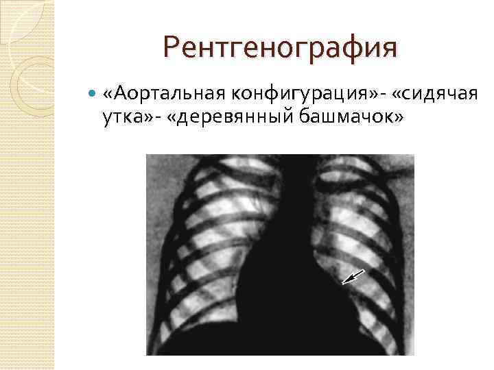 Увеличено левое. Недостаточность аортального клапана рентген. Аортальнаяная конфигурация рентген. Рентген сердца при аортальной недостаточности. Аортальная конфигурация сердца рентген.